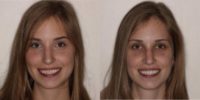 18-24 year old woman treated with Porcelain Veneers