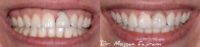 18-24 year old woman treated with Dental Implants