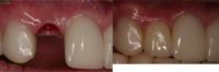 45-54 year old woman treated with Dental Implants