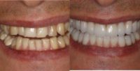 25-34 year old man treated with Porcelain Veneers