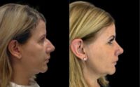 45-54 year old woman treated with Rhinoplasty