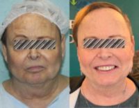 55-64 year old woman treated with Renuvion Skin Tightening