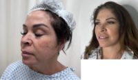 45-54 year old woman treated with Facelift, Eyelid Surgery