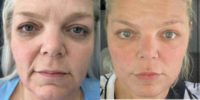 35-44 year old woman treated with Facial Fat Transfer