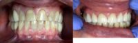 55-64 year old woman treated with Smile Makeover