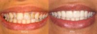 Full porcelain crowns - Tooth whitening was done to brighten up the smile