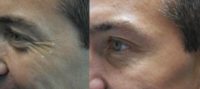 35-44 year old man treated with Botox