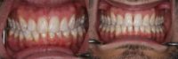 35-44 year old man treated with Invisalign