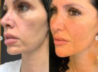 woman treated with Sculptra Aesthetic