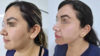 25-34 year old woman treated with Buccal Fat Removal