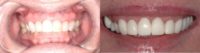 45-54 year old woman treated with Dental Crowns
