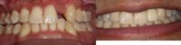 Missing lateral incisor