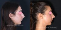 18-24 year old woman treated with Rhinoplasty