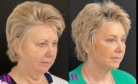 Woman treated with Mini Facelift