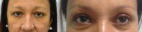 55-64 year old woman treated with Eye Bags Treatment