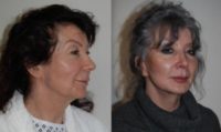 69 year old woman treated with Lower Facelift