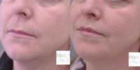 Woman treated with Lip Lift