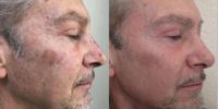 Man treated with Halo Laser 3 months after 1 treatment