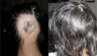 25-34 year old woman treated with PRP for Hair Loss