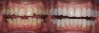 55-64 year old man treated with A Smile Makeover