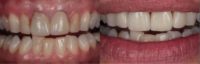 45-54 year old woman treated with Dental Crown