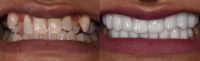 35-44 year old woman treated with Dental Implants and Porcelain Veneers