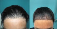 35-44 year old woman treated with FUE Hair Transplant