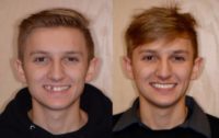 18-24 year old man treated with Smile Makeover