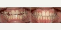 18-24 year old woman treated with Damon Braces