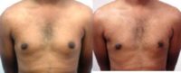 26 year old man treated with Male Breast Reduction