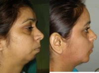 Woman treated with Chin Surgery