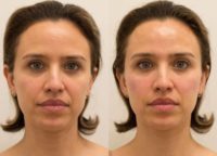 Woman treated with Dermal Fillers