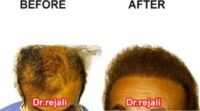 Woman treated with Hair Transplant