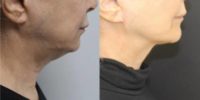 55-64 year old woman treated with Facelift, Lower Facelift, Neck Lift, SMAS Facelift