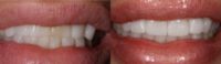 55-64 year old woman treated with Porcelain Veneers