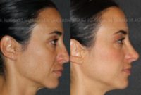 18-24 year old woman treated with Rhinoplasty