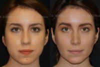 18-24 year old woman treated with Rhinoplasty