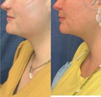 35-44 year old woman treated with Chin Liposuction