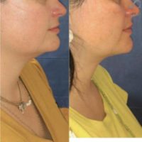 35-44 year old woman treated with Chin Liposuction