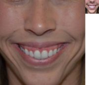 Young woman treated with Botox for gummy smile