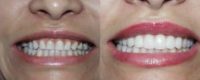 Porcelain Veneers