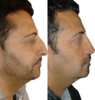 35-44 year old man treated with Rhinoplasty