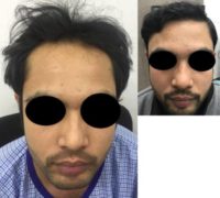 25-34 year old man treated with Hair Transplant