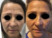 45-54 year old woman treated with Facelift