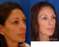 49 year old woman treated with Eyelid Surgery
