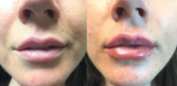 18-24 year old woman treated with Injectable Fillers