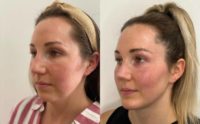 25-34 year old woman treated with Rhinoplasty, Chin Implant