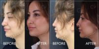 18-24 year old woman treated with Chin Liposuction