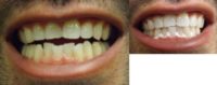 Young Male After ZOOM Teeth Whitening