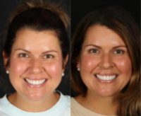 Woman treated with Smile Makeover